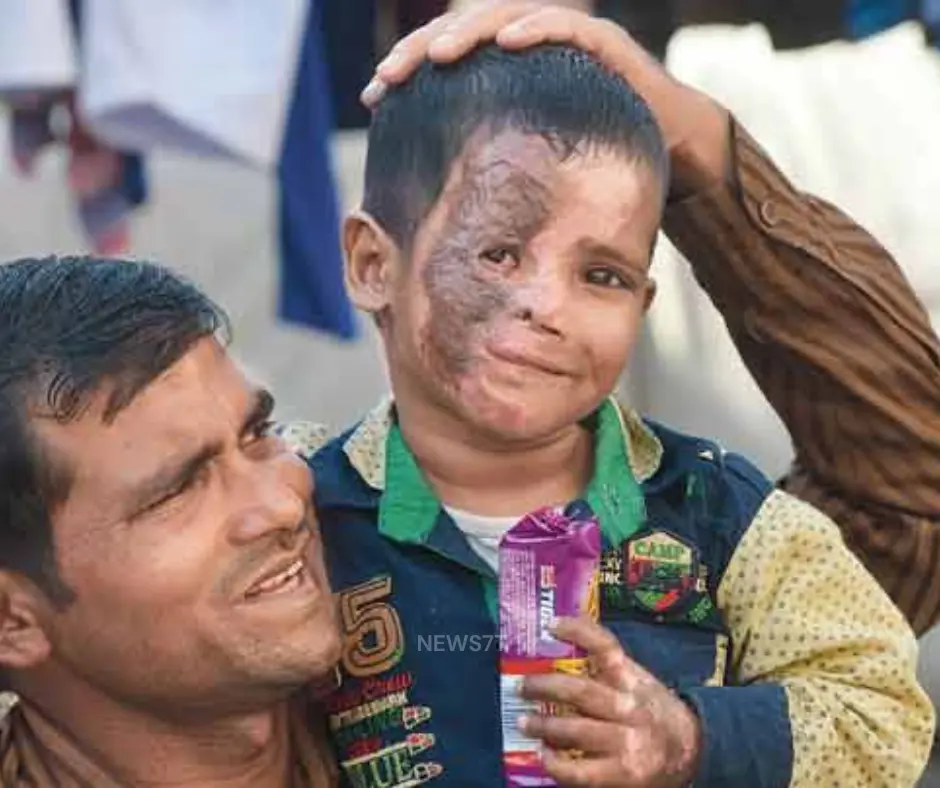 Acid Attack Survivor Sapna’s 10-Year Legal Battle: From Pain to Rs 12 Lakh Justice Under DVCS and NALSA (photo 4)
