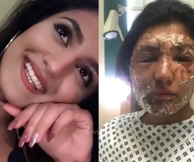 Acid Attack Survivor Sapna’s 10-Year Legal Battle: From Pain to Rs 12 Lakh Justice Under DVCS and NALSA